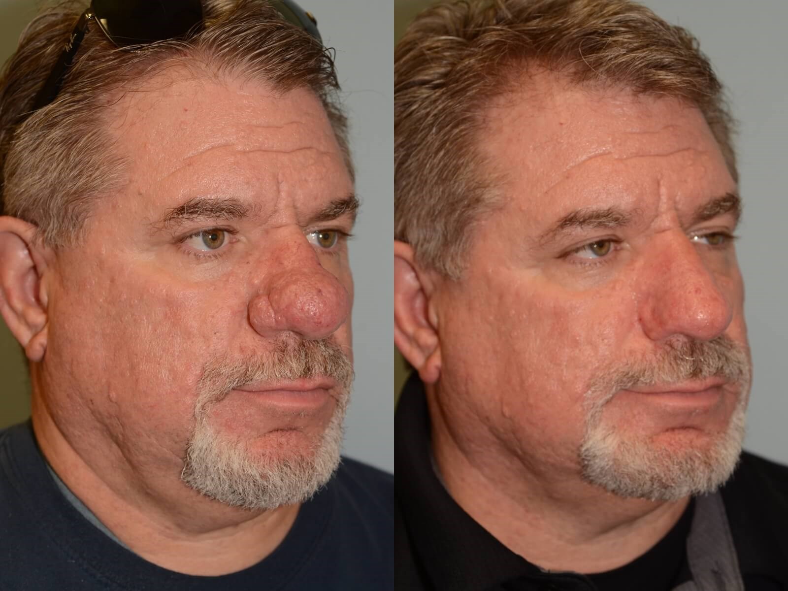 Removal of Rhinophyma Restores Nasal function! | Case 31820