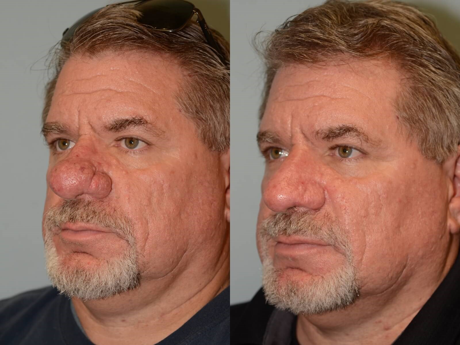 Removal of Rhinophyma Restores Nasal function! | Case 31820