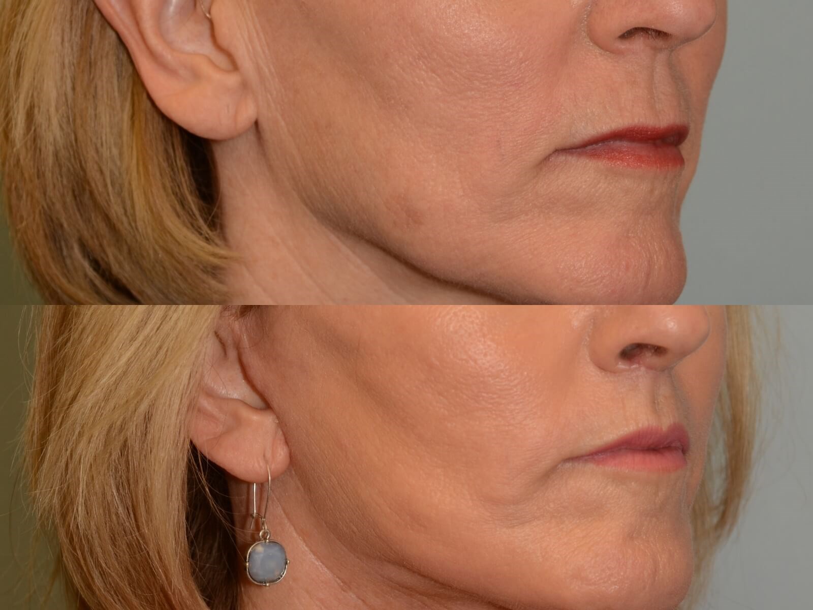 Beautiful Cupids Bow with Lift Before and After