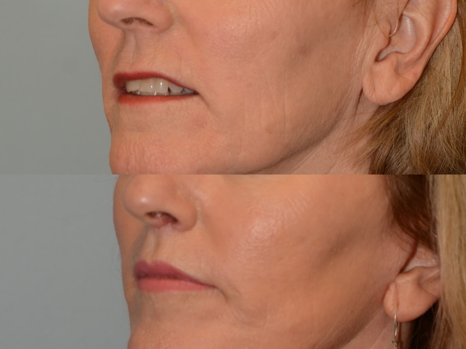 Beautiful Cupids Bow with Lift Before and After