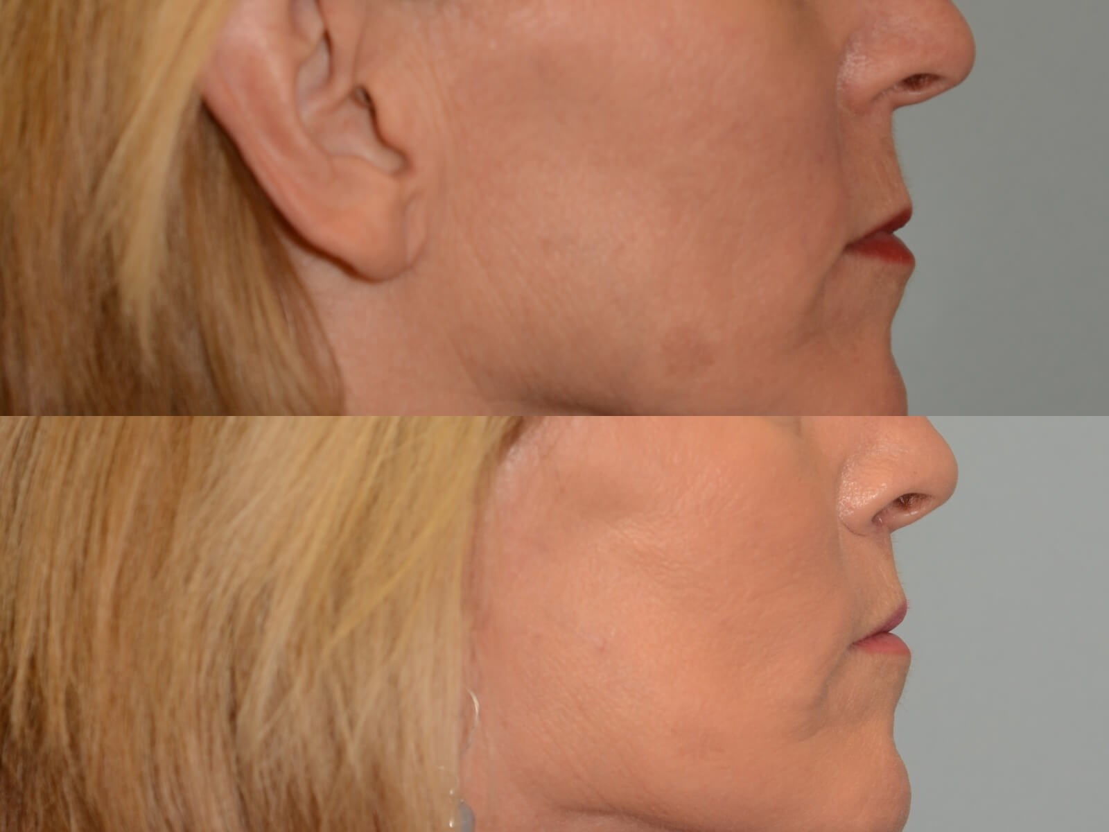 Subtle Enhancement Before and After