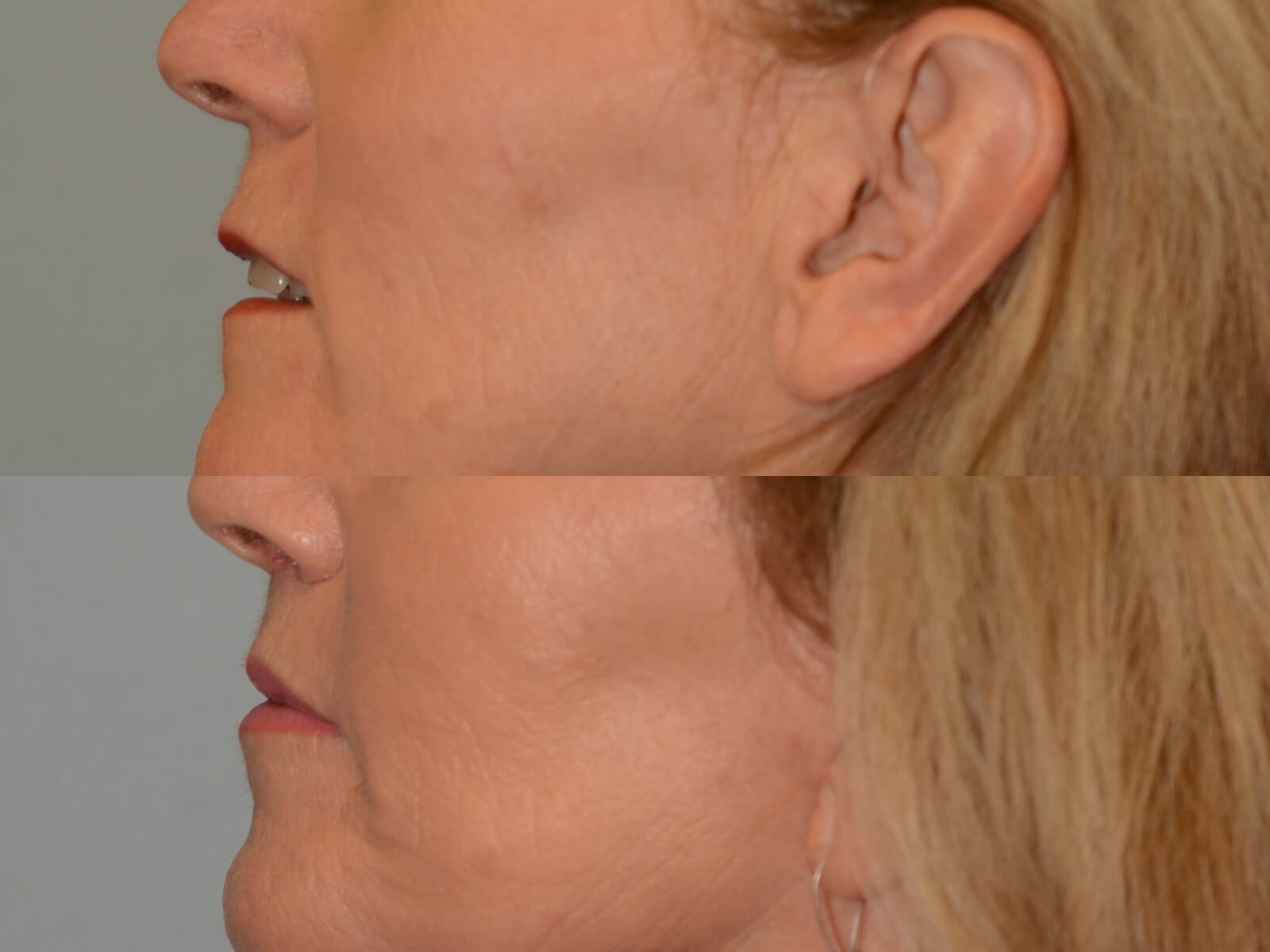 Subtle Enhancement Before and After