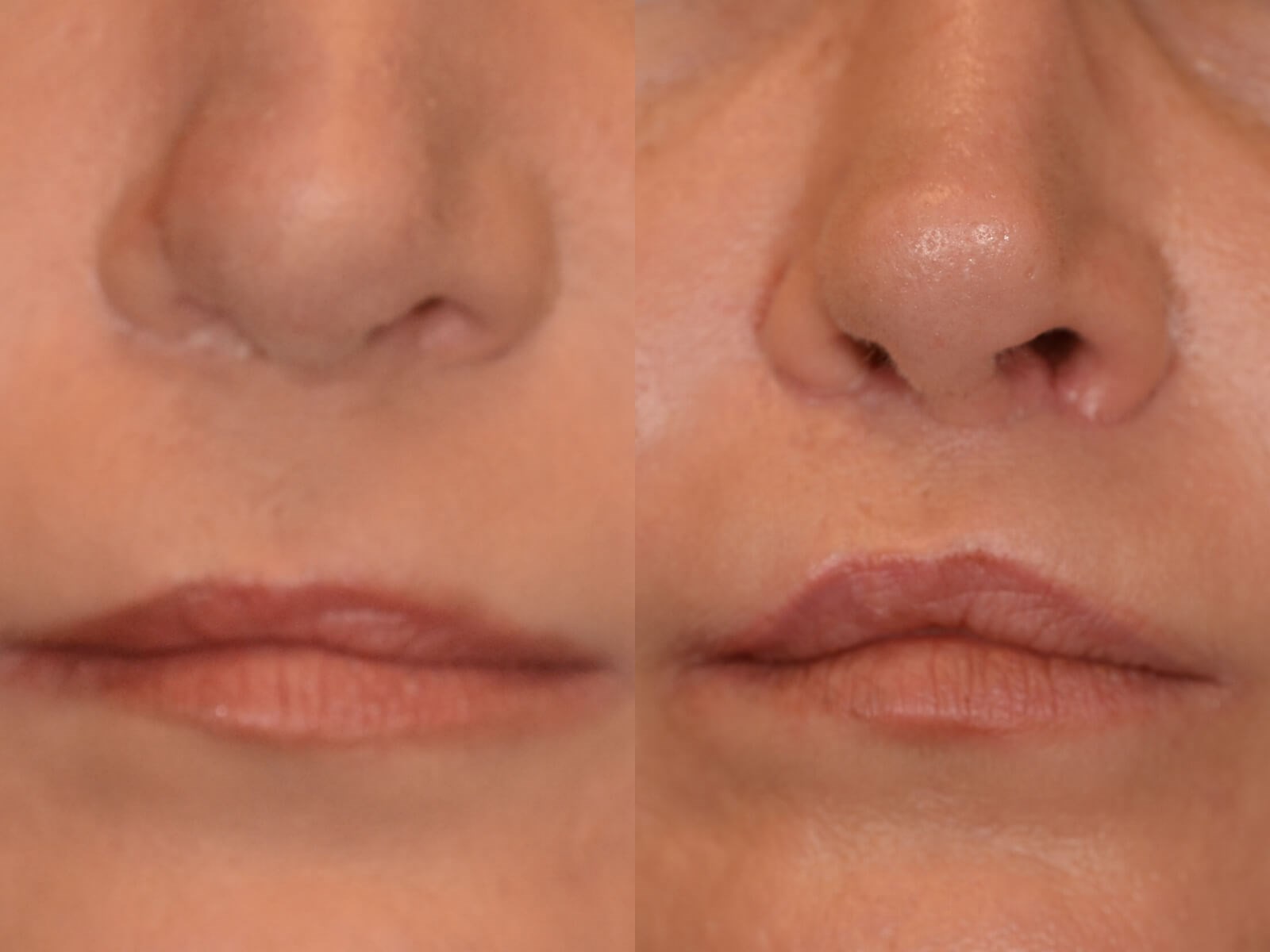 LipLift after Cleft lip repair Before and After