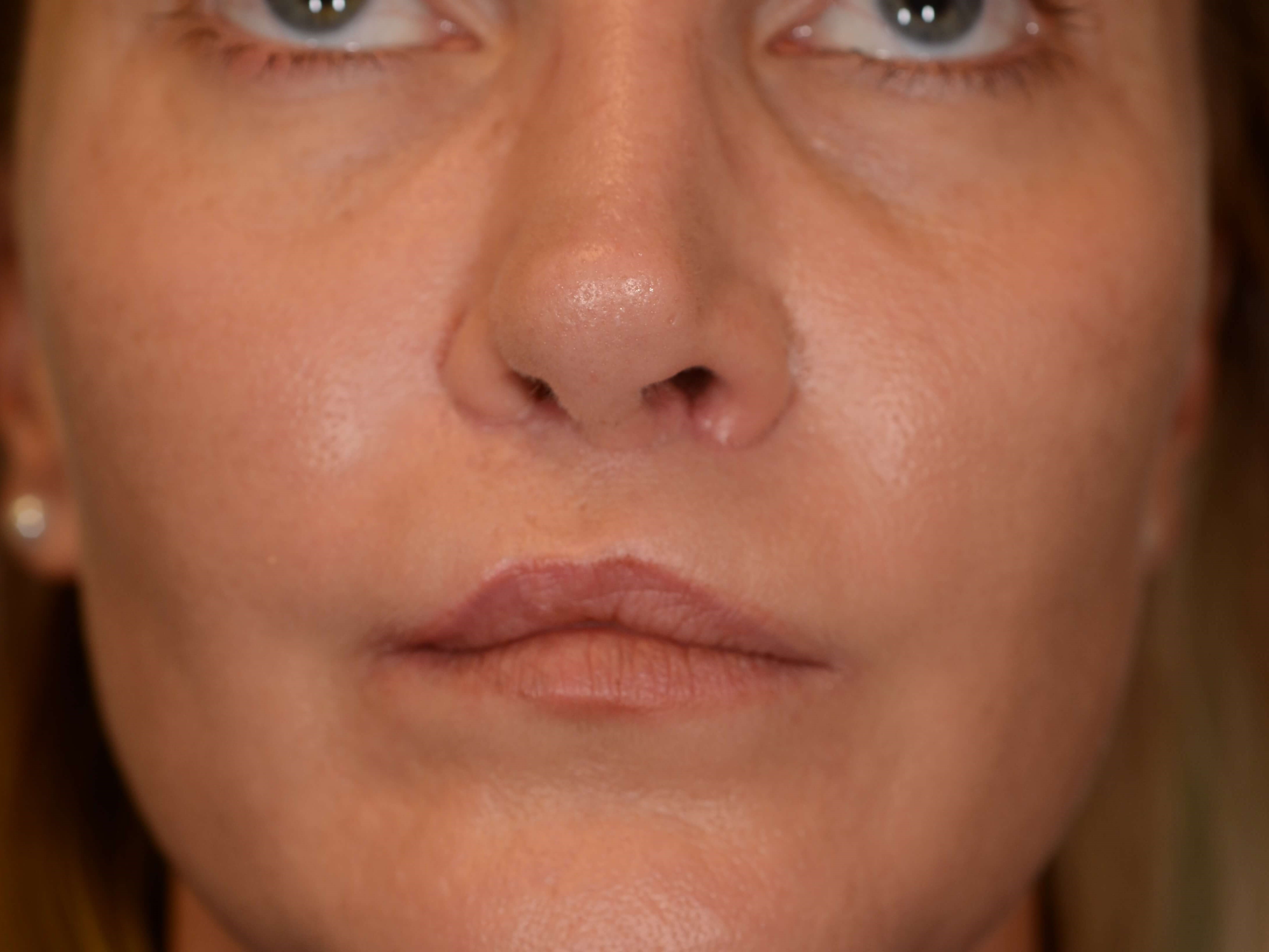 LipLift after Cleft lip repair After
