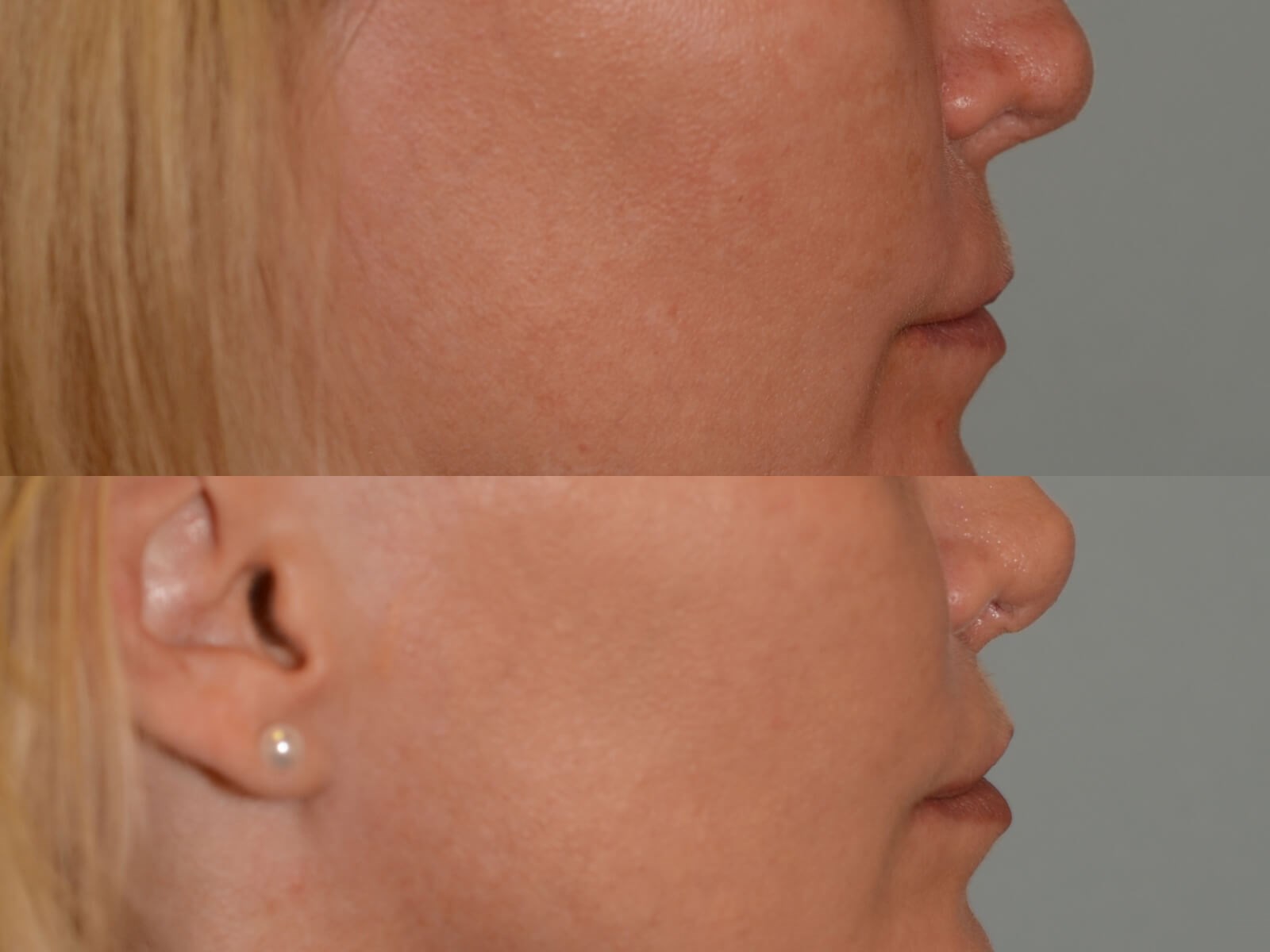 Lip Lift Before and After