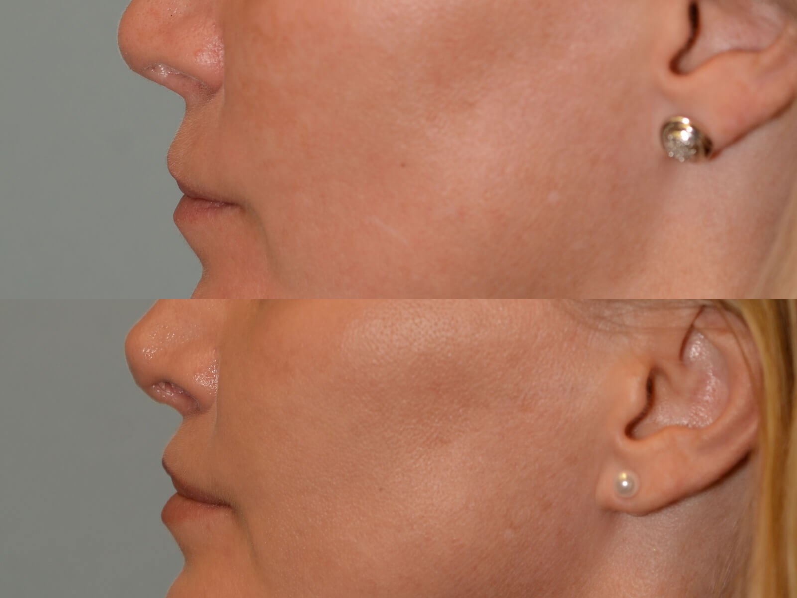 Lip Lift Before and After