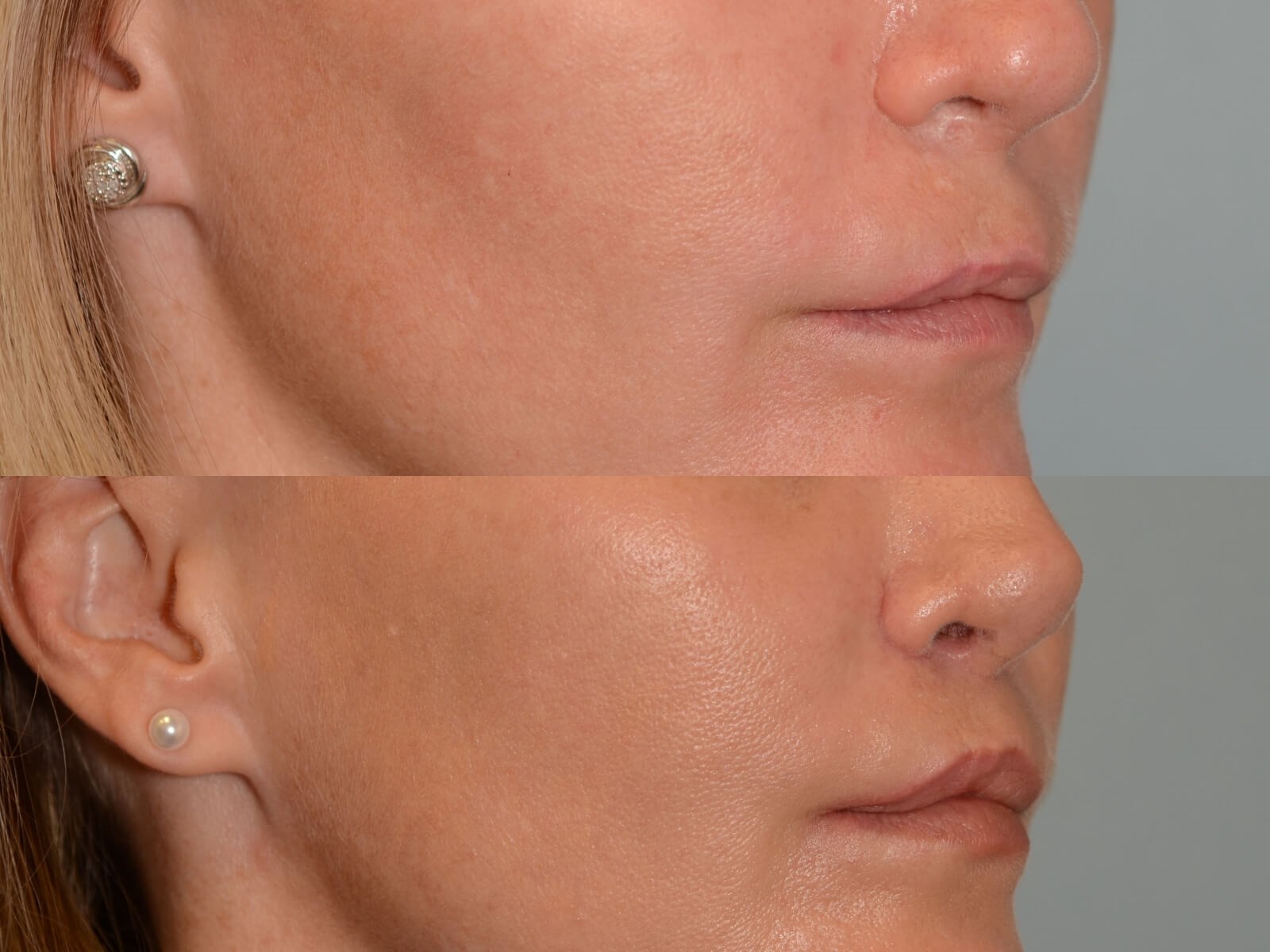 Lip Lift Before and After