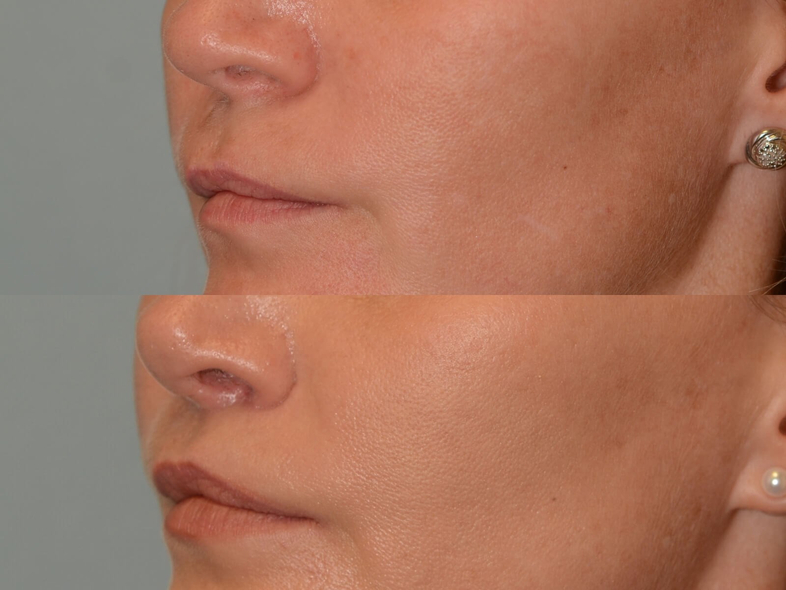 Lip Lift Before and After