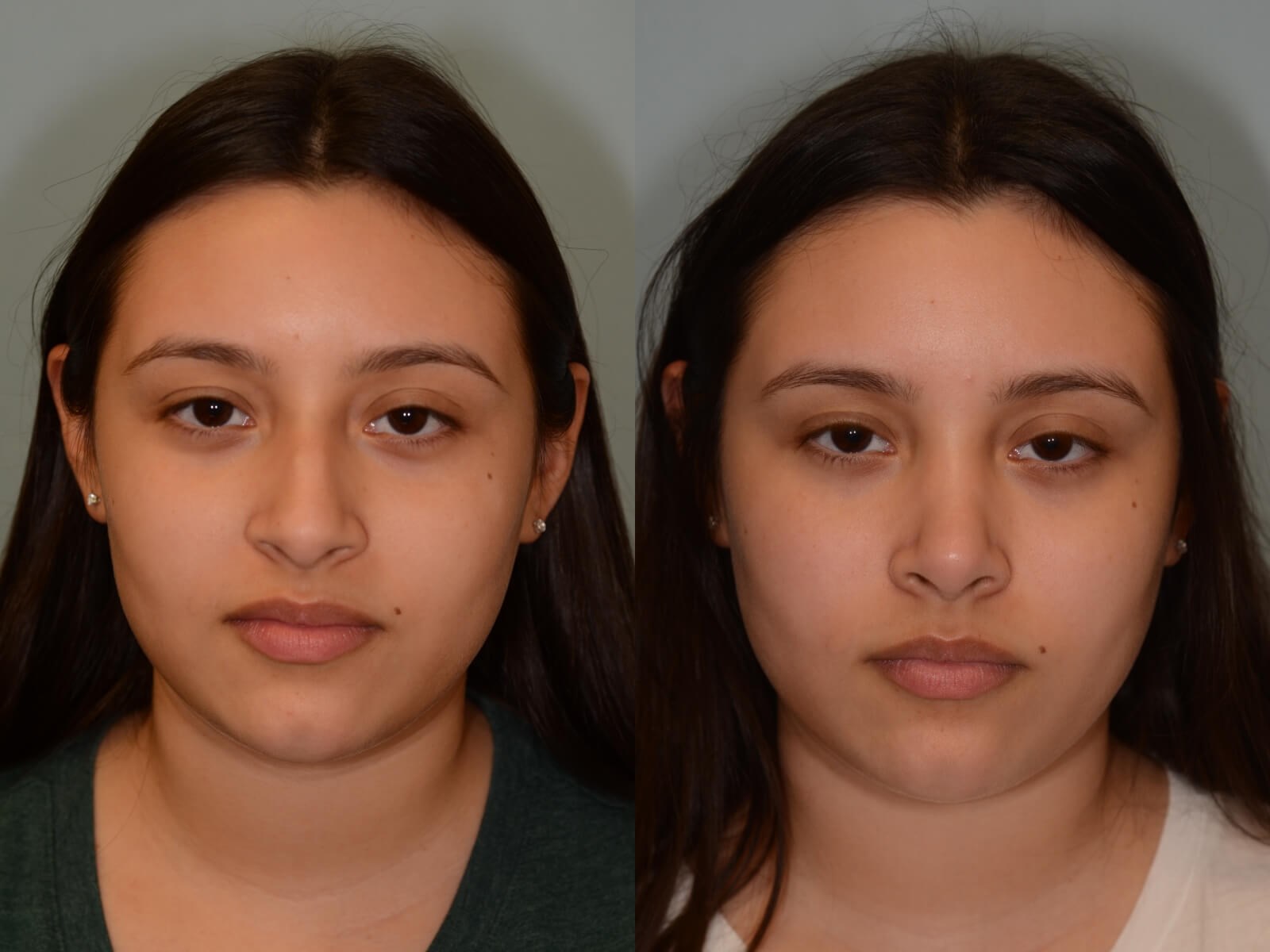 Rhinoplasty Before and After