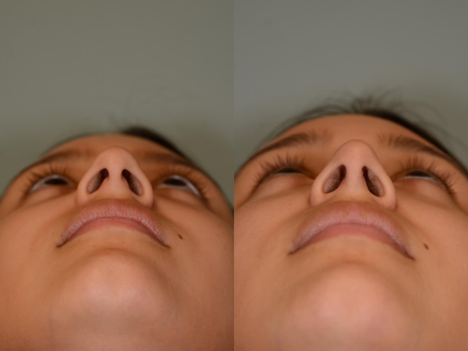 Rhinoplasty Before and After