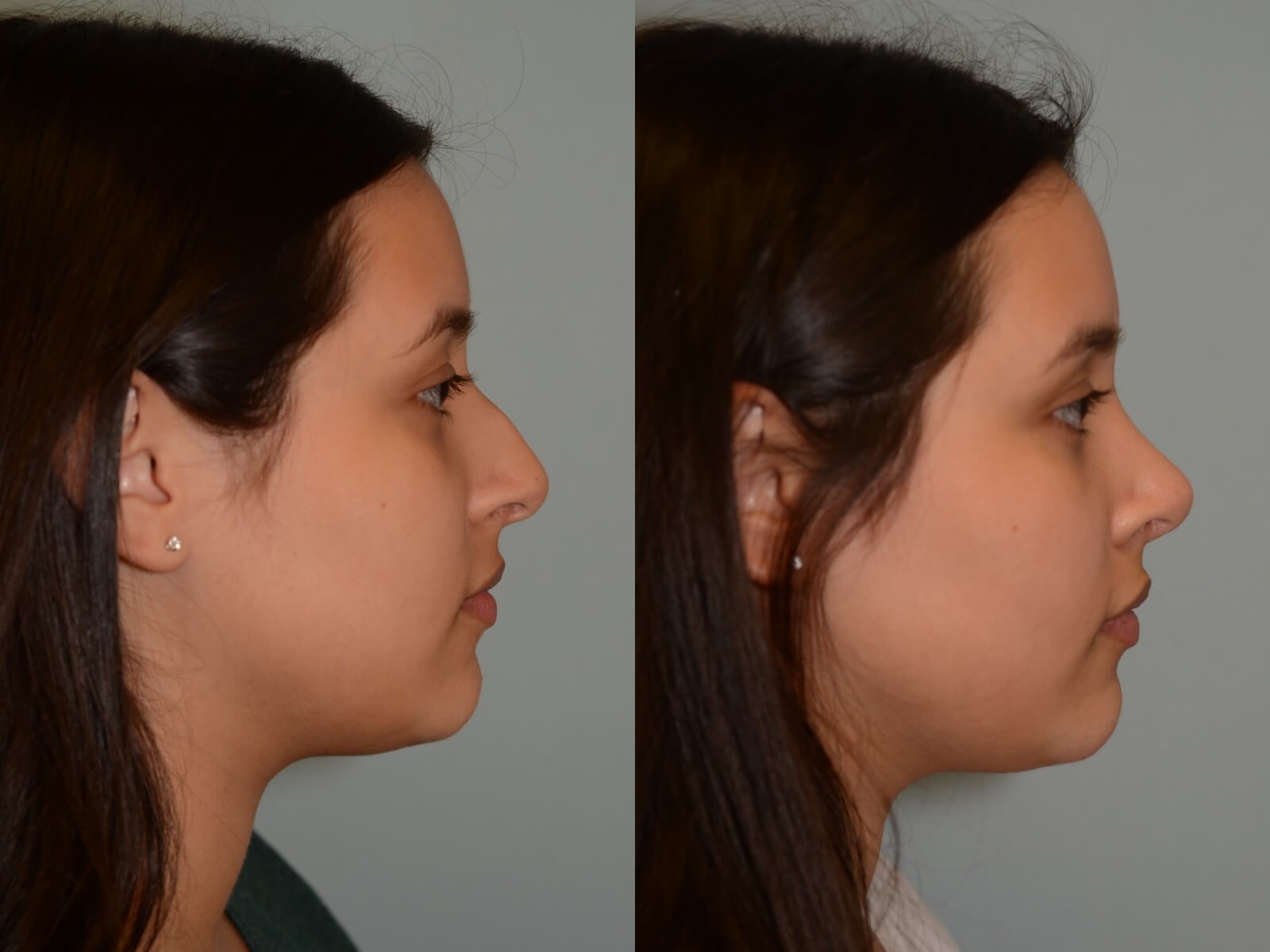 Rhinoplasty Before and After