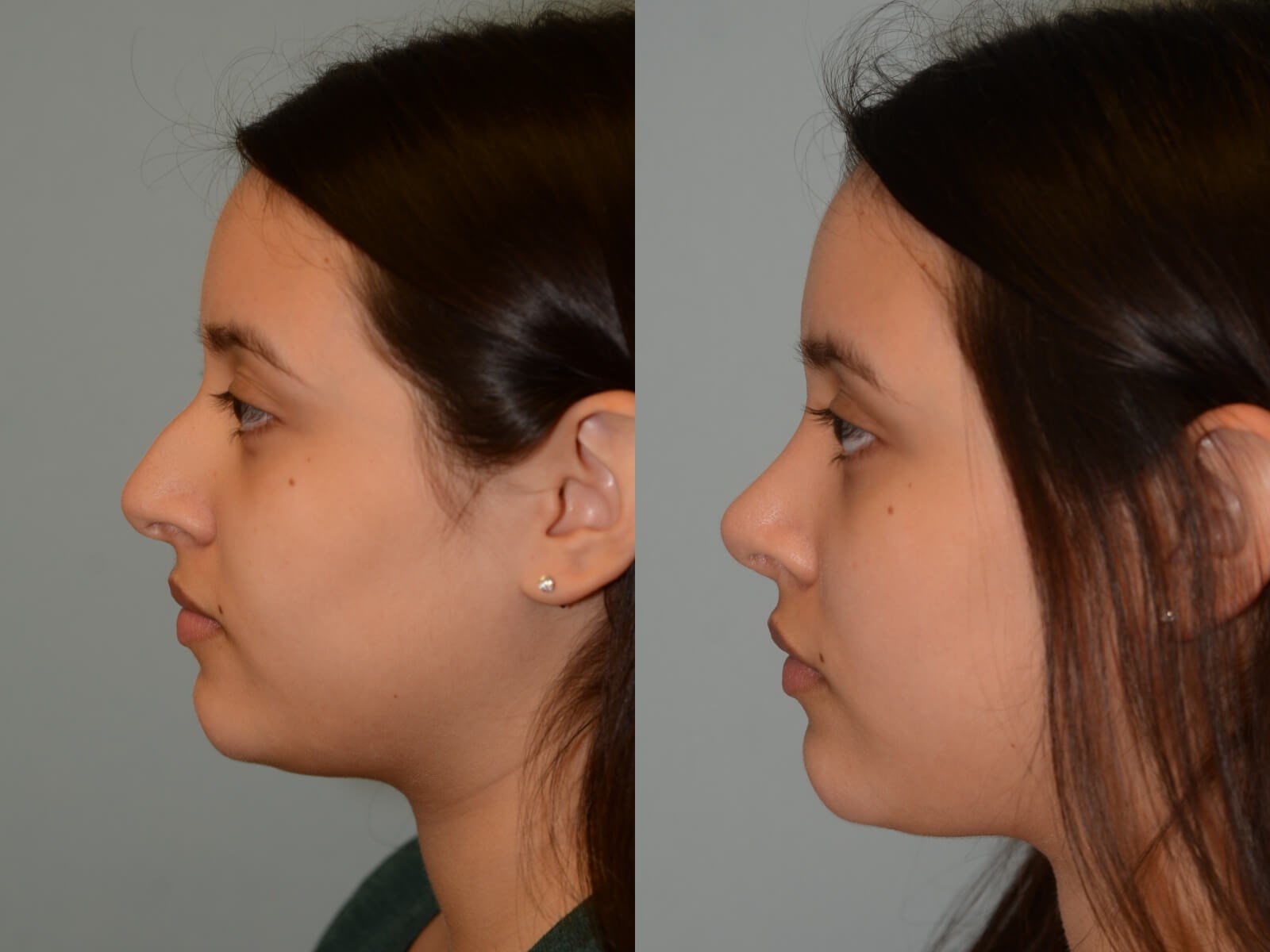 Rhinoplasty Before and After