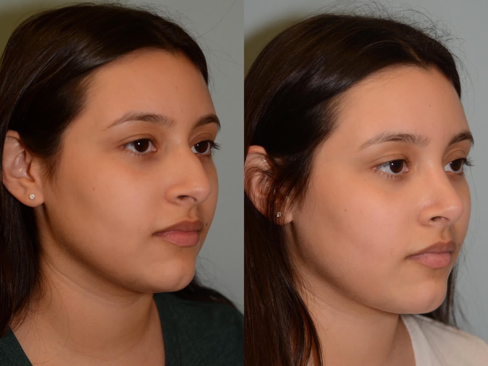 Rhinoplasty Before and After