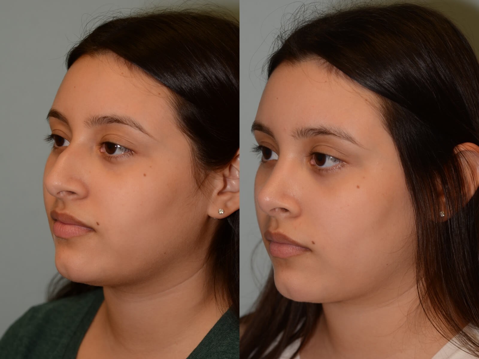 Rhinoplasty Before and After
