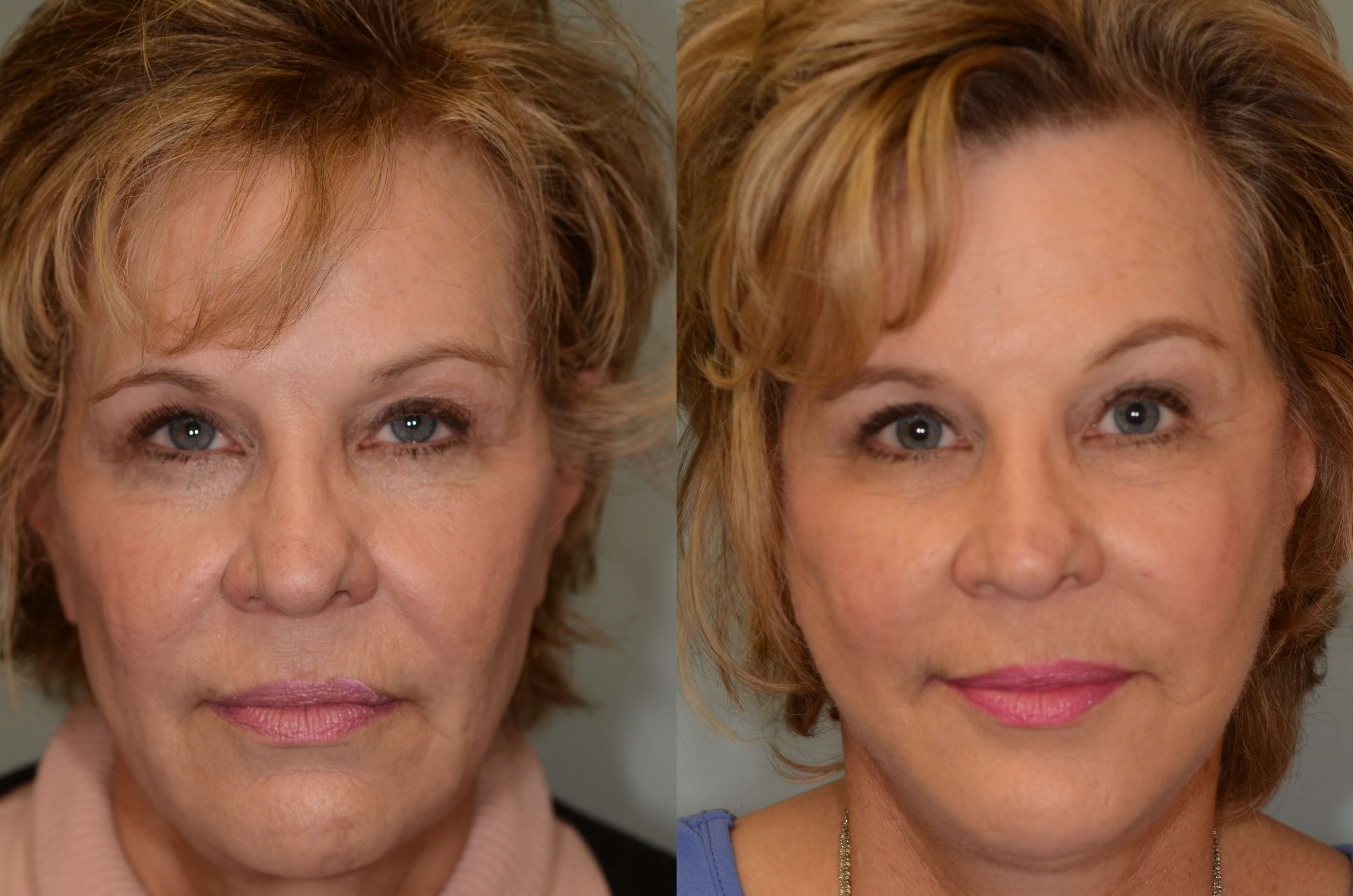 Facelift, Necklift Houston Before and After
