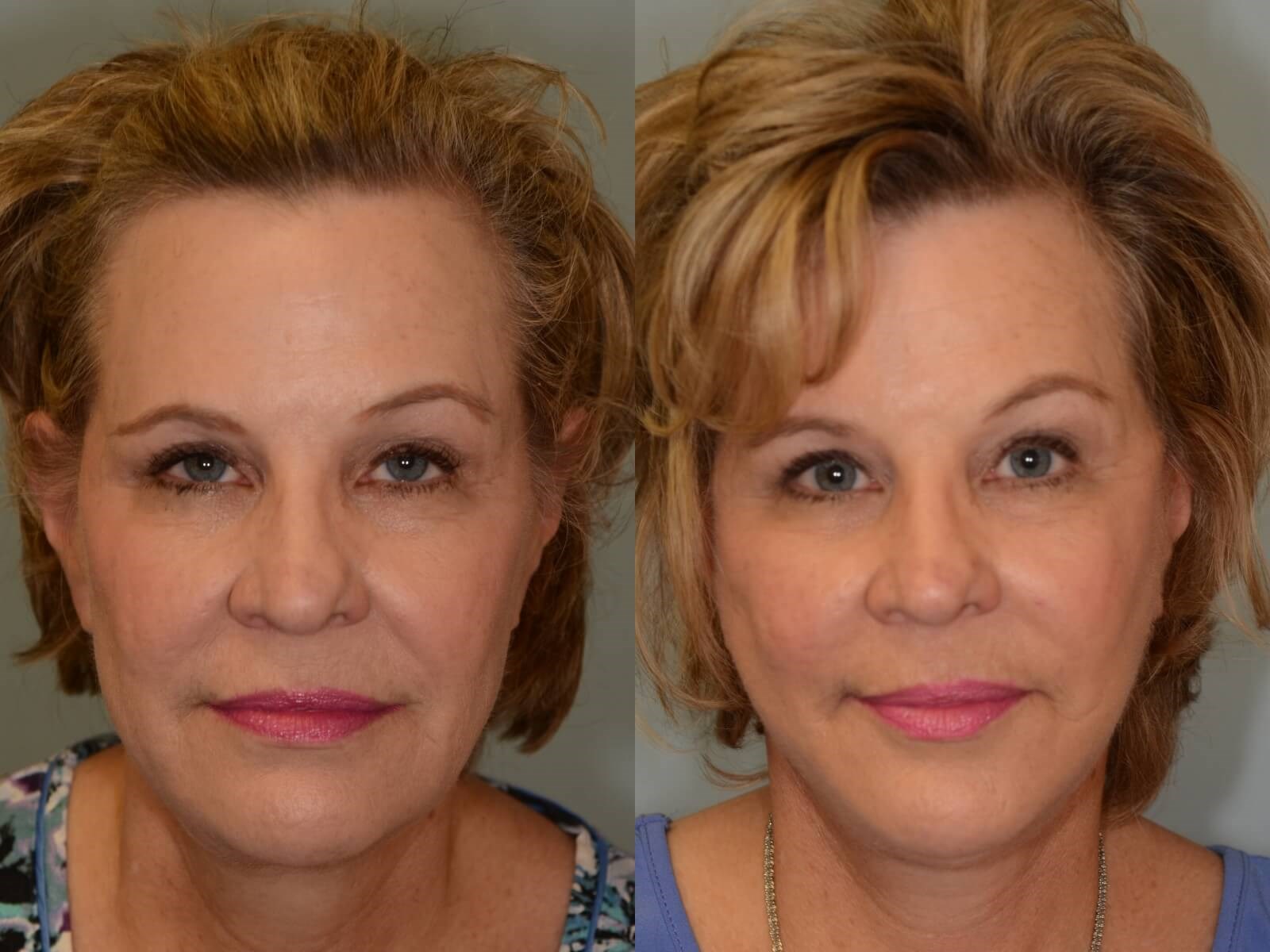 Facelift, Necklift Houston Before and After