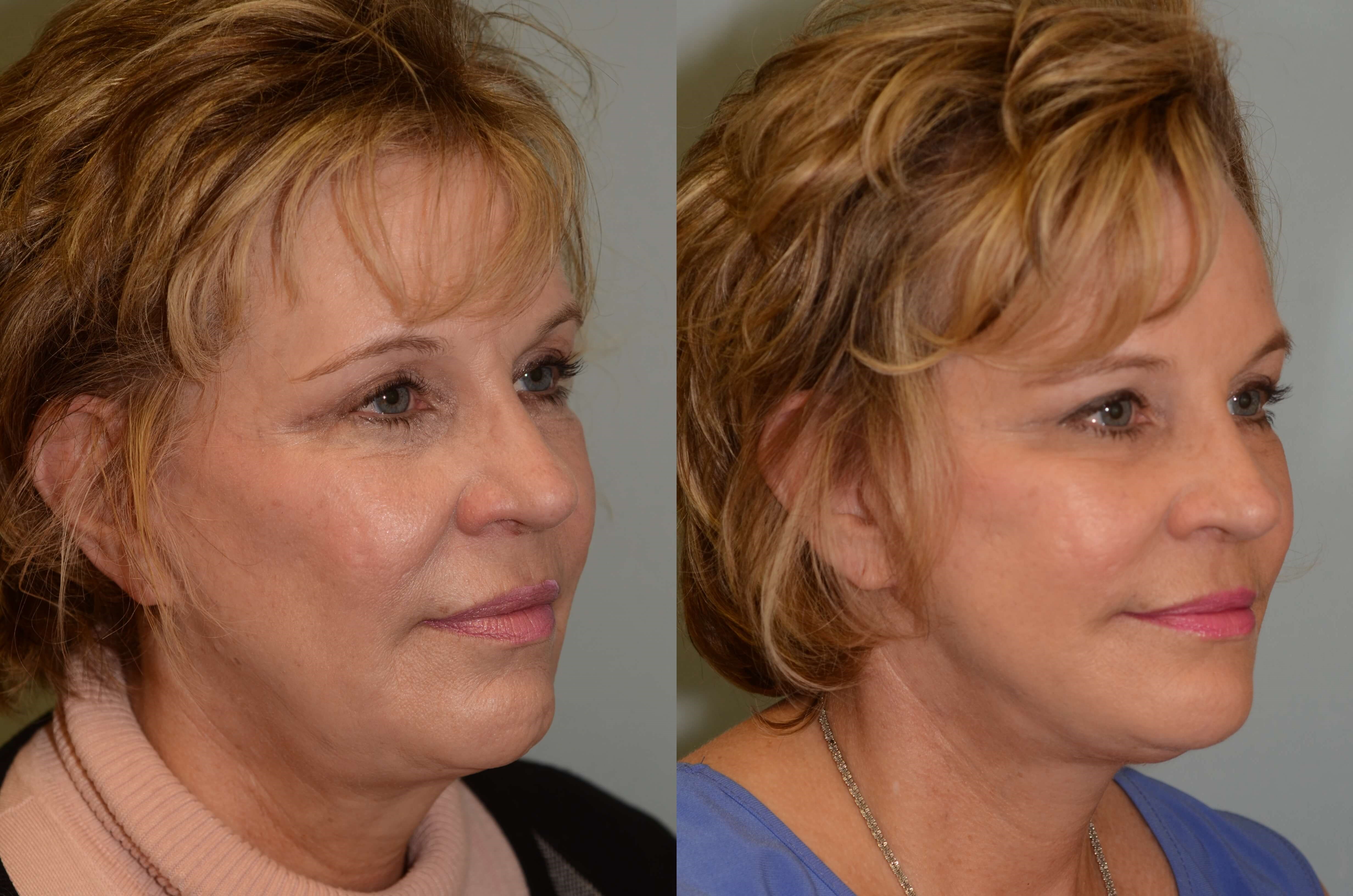 Soft uplifting to midface Before and After