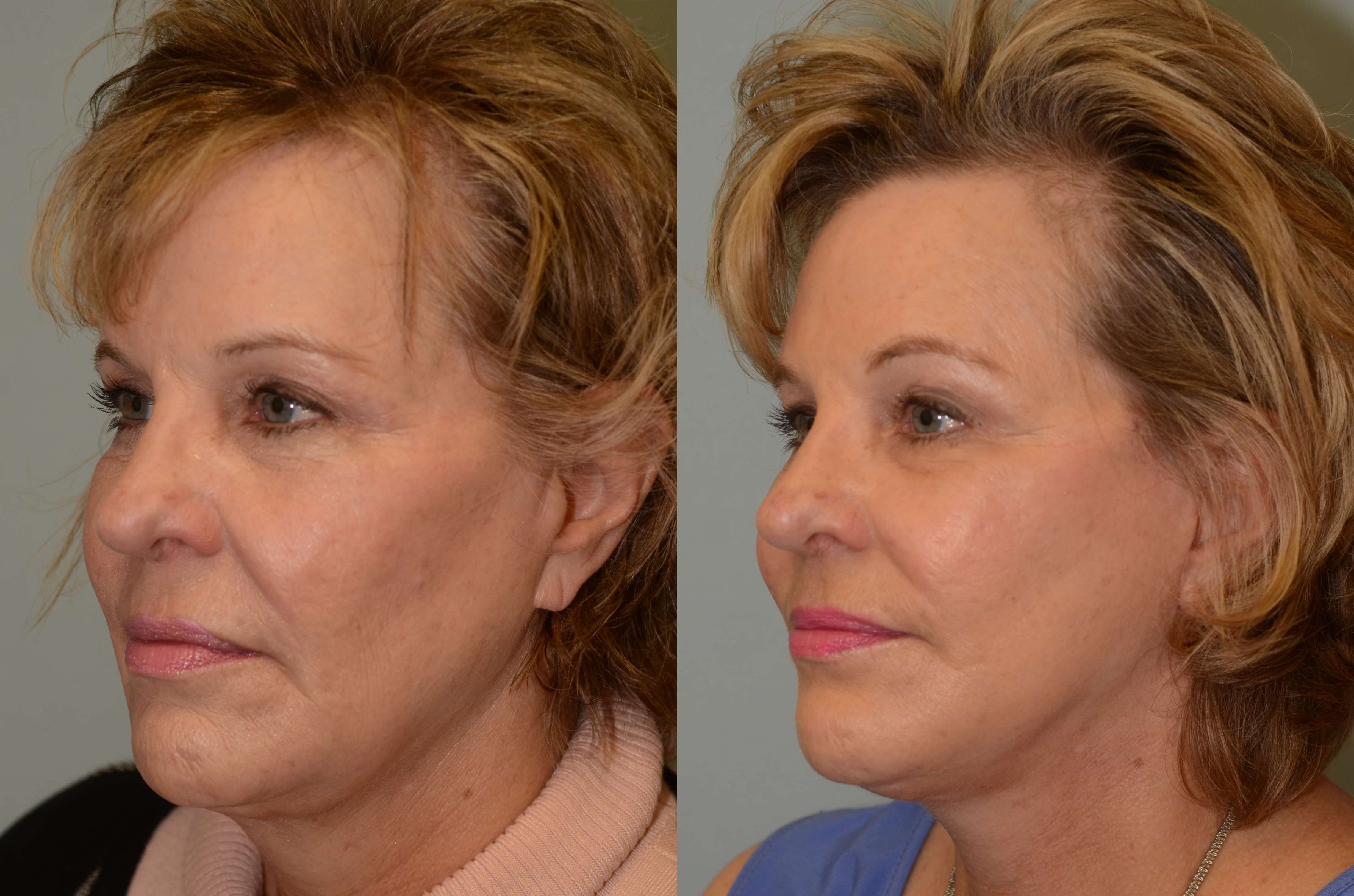 Soft uplifting to midface Before and After