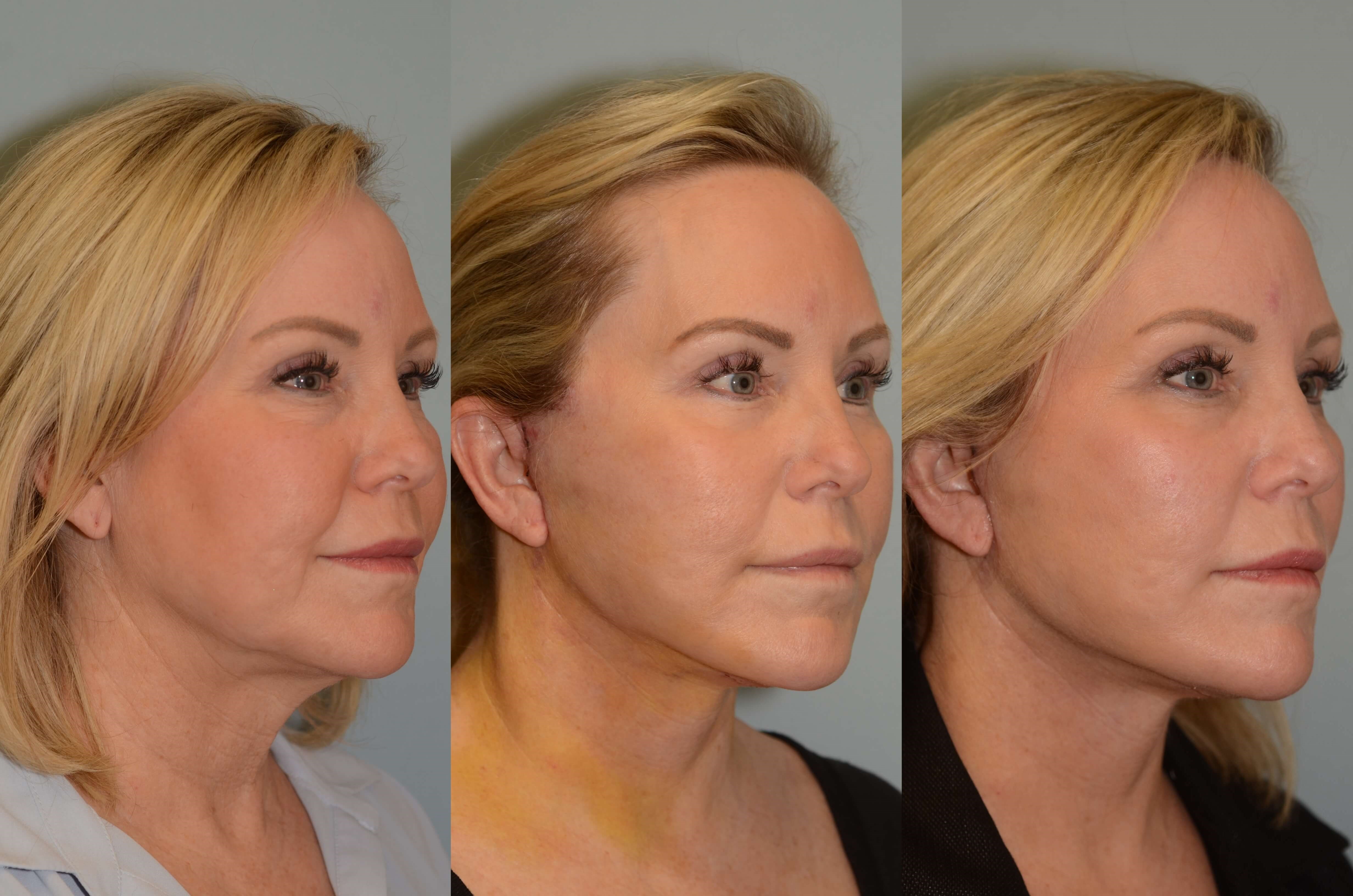 Facelift, Necklift Before and After