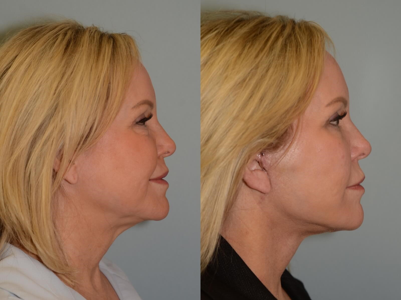 Facelift, Neck lift Before and After