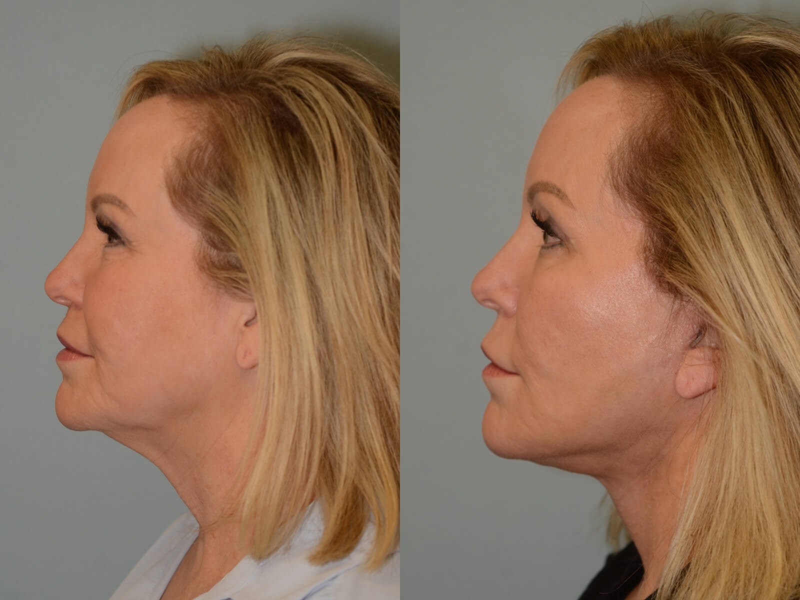 Facelift, Neck lift Before and After