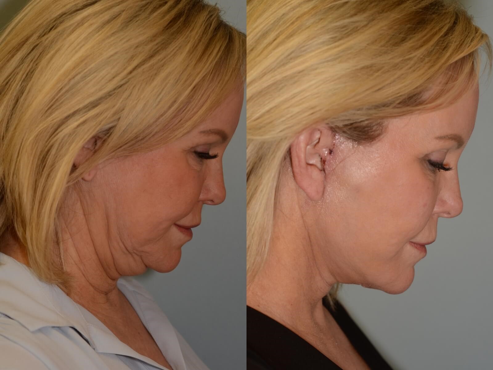 Facelift, Neck lift Before and After