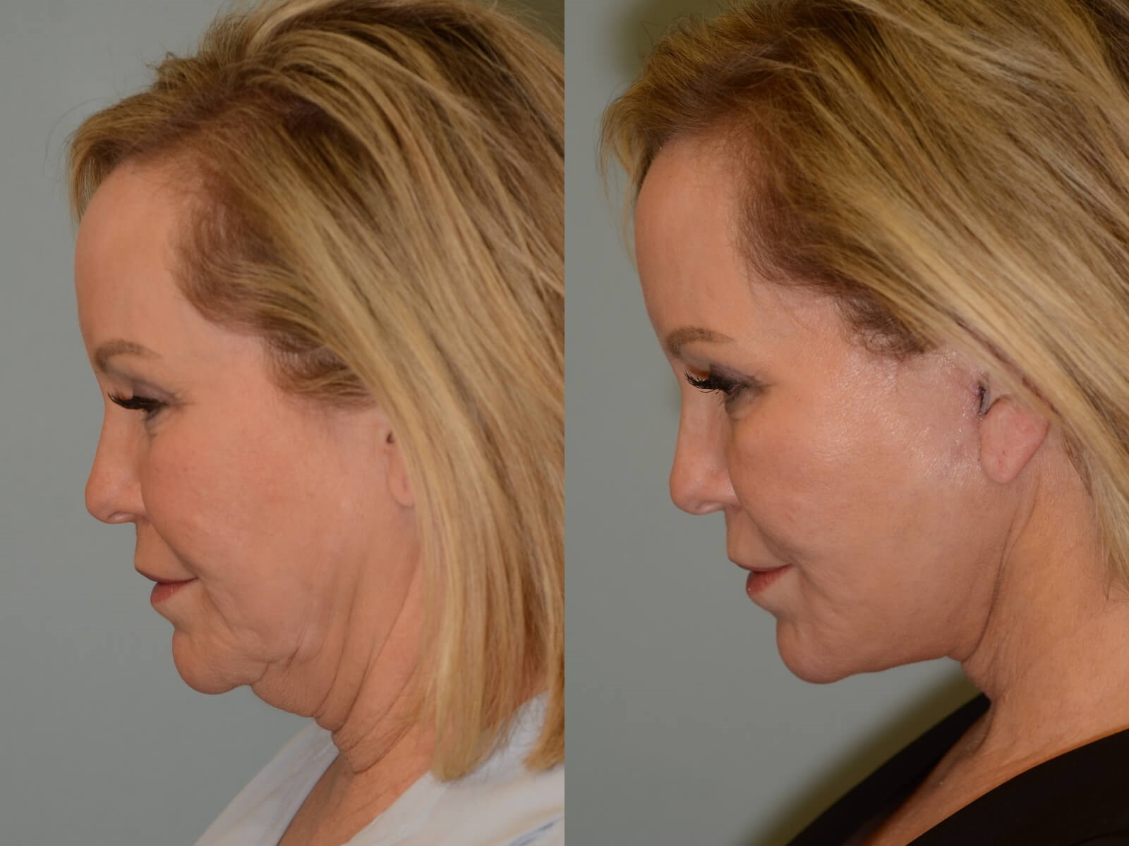 Facelift, Neck lift Before and After