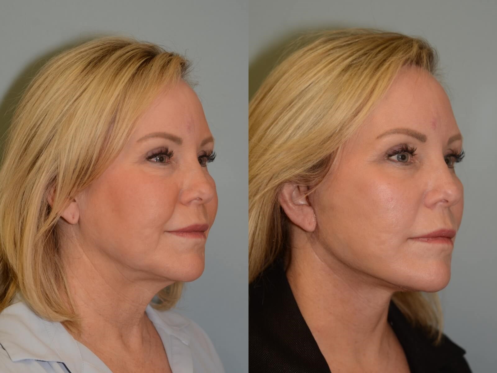 Facelift, Neck lift Before and After