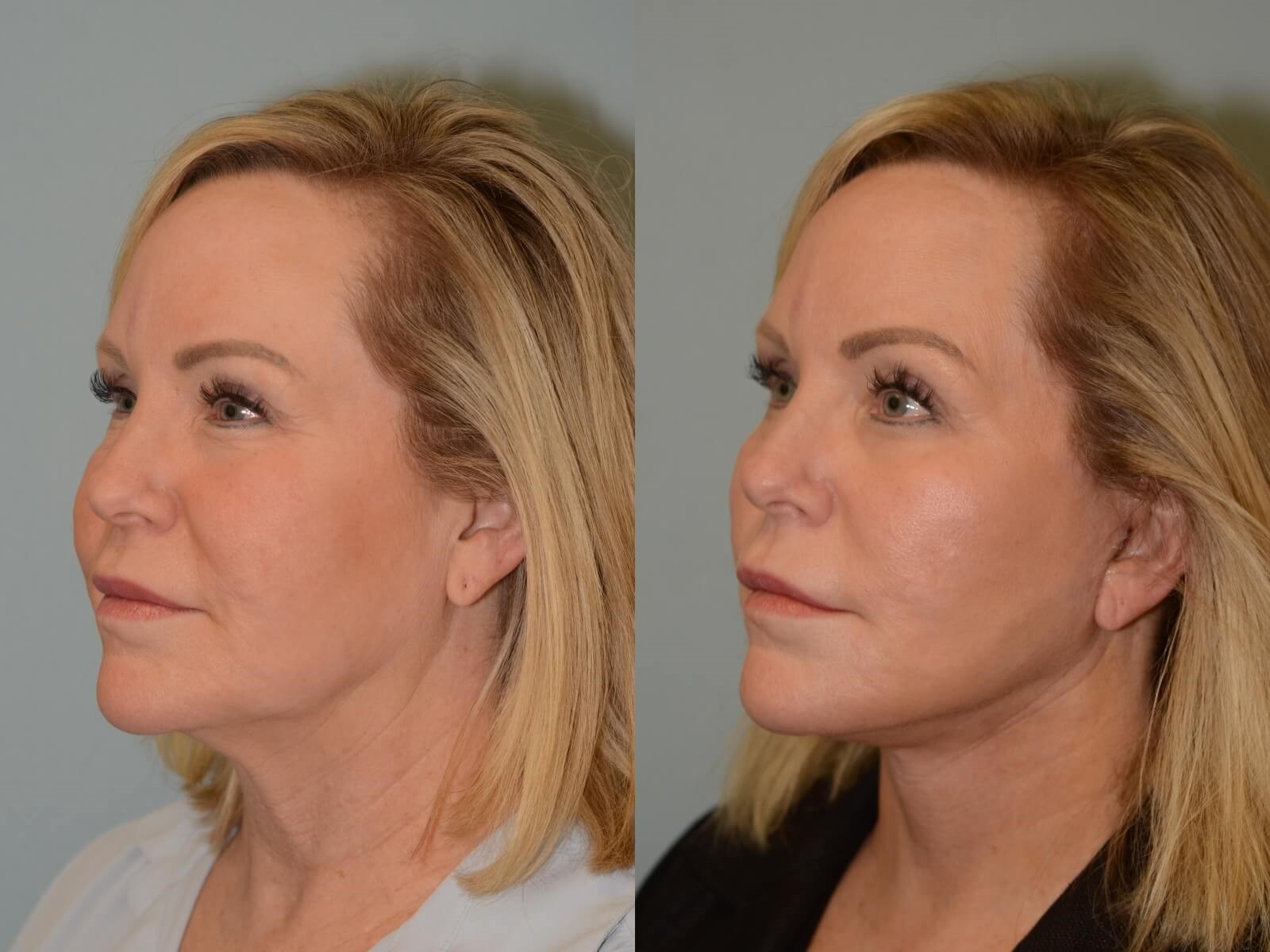 Facelift, Neck lift Before and After