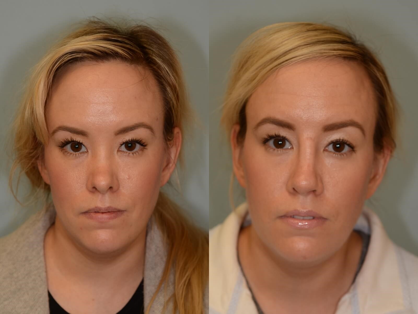 Nasal Reconstruction Before and After