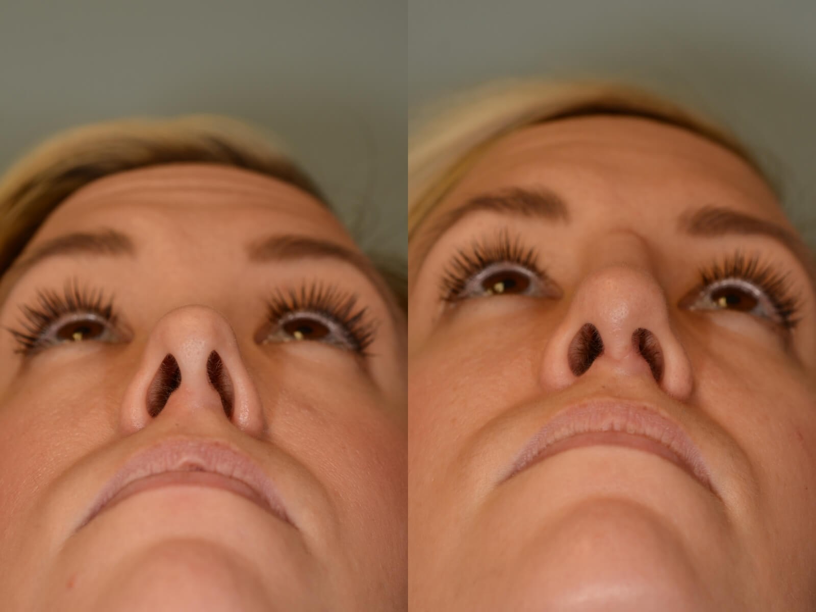 Nasal Reconstruction Before and After