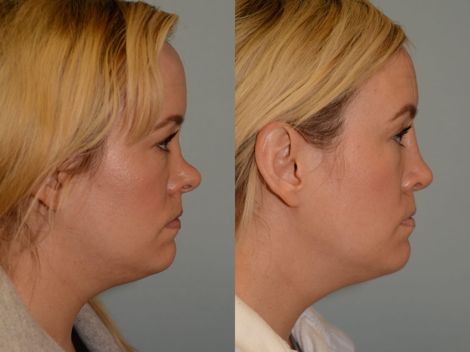 SeptoRhinoplasty Before and After