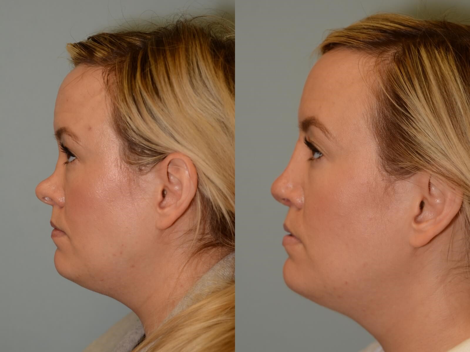 SeptoRhinoplasty Before and After