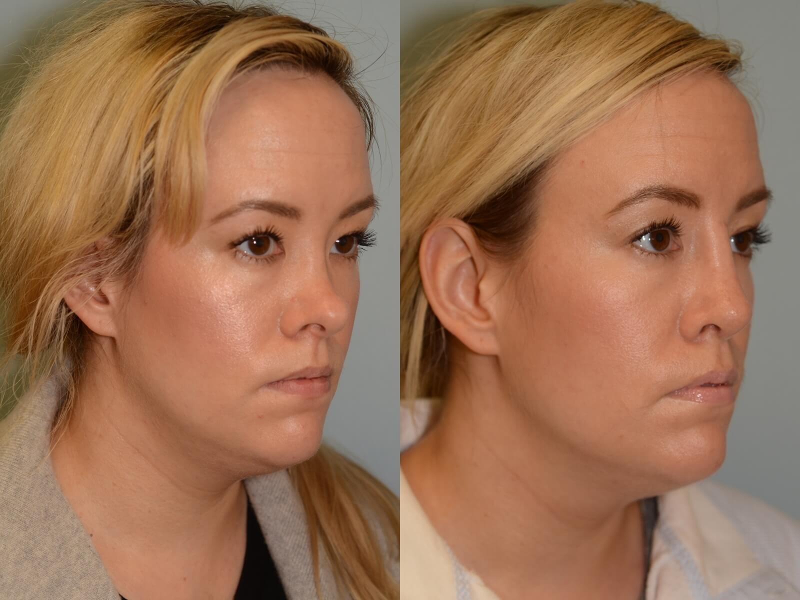 Nasal Reconstruction Before and After