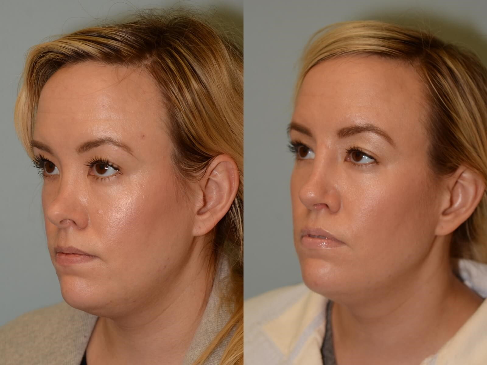 Nasal Reconstruction Before and After