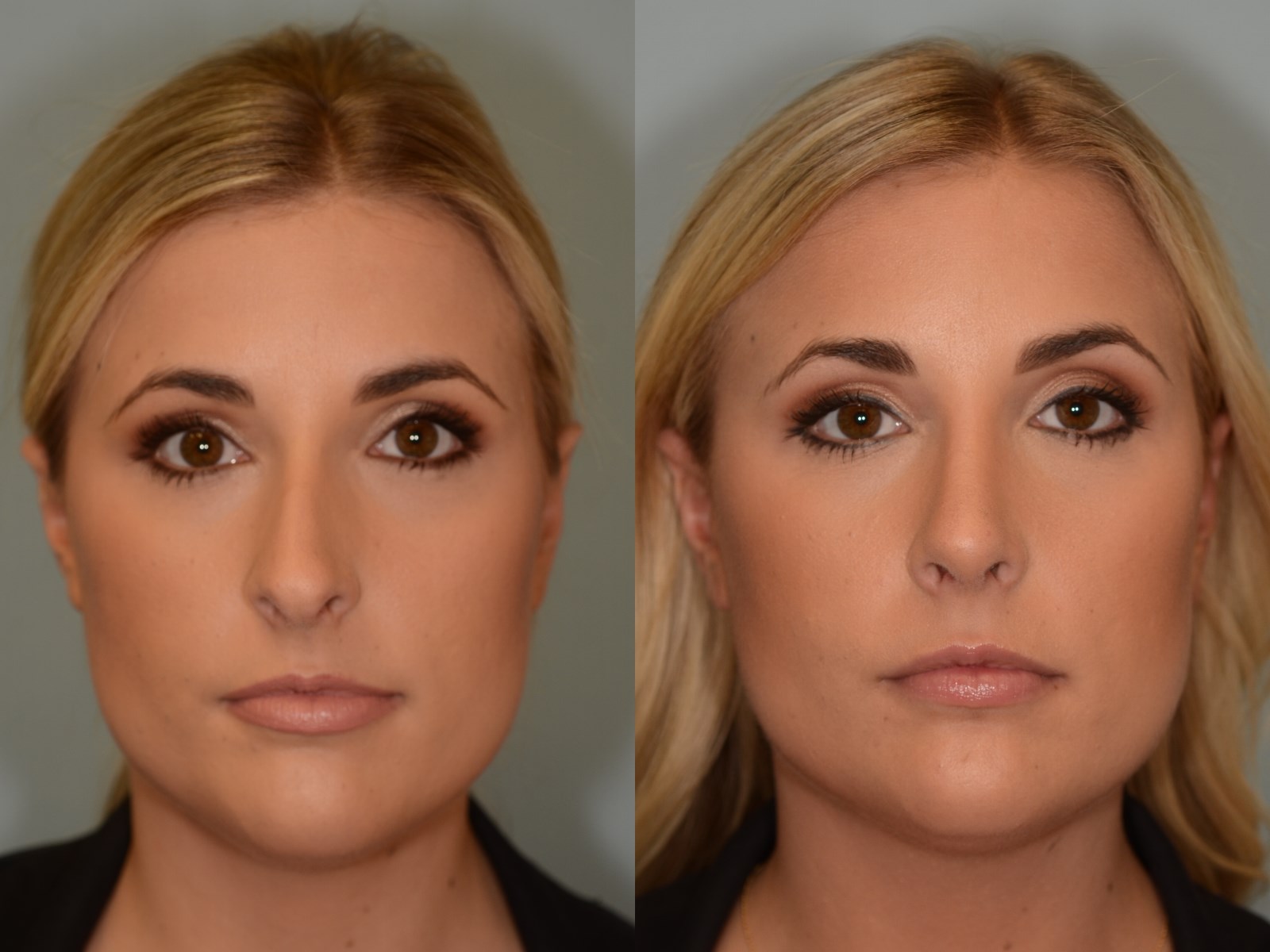 SeptoRhinoplasty Before and After