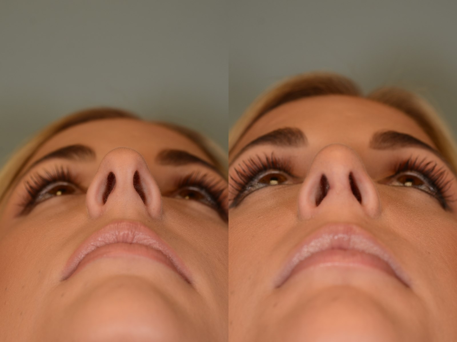 SeptoRhinoplasty Before and After