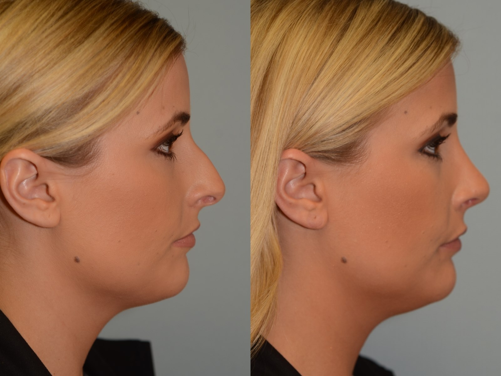 No more dorsal hump! Before and After