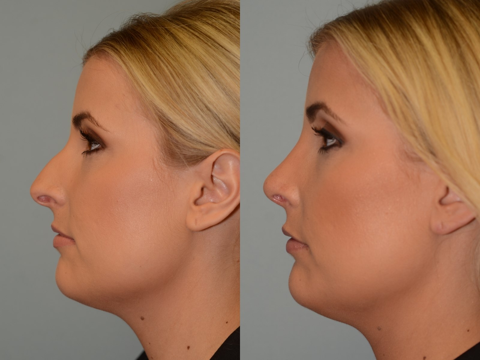 No more dorsal hump! Before and After