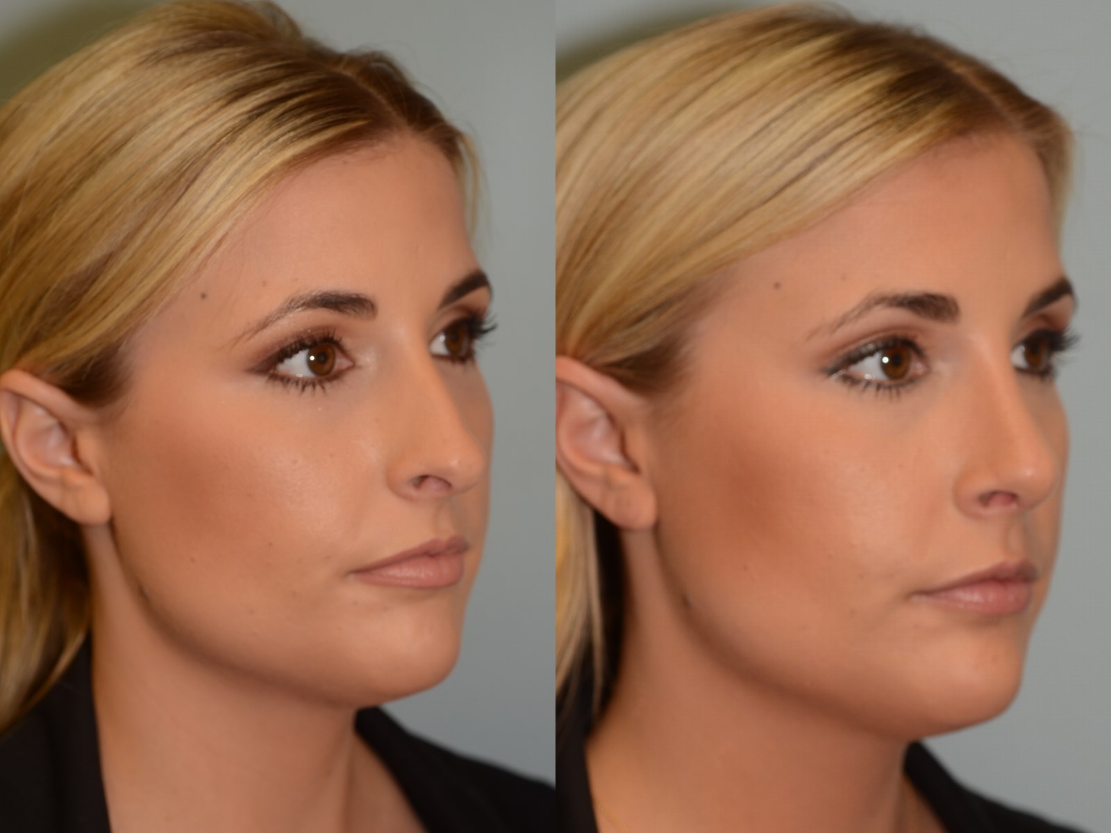 Soft Natural Slope Before and After