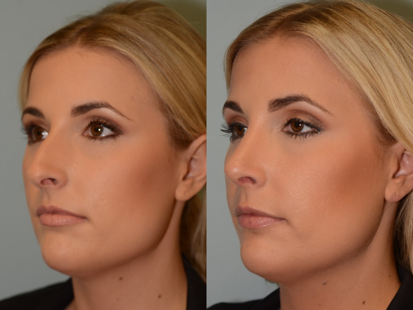 Soft Natural Slope Before and After