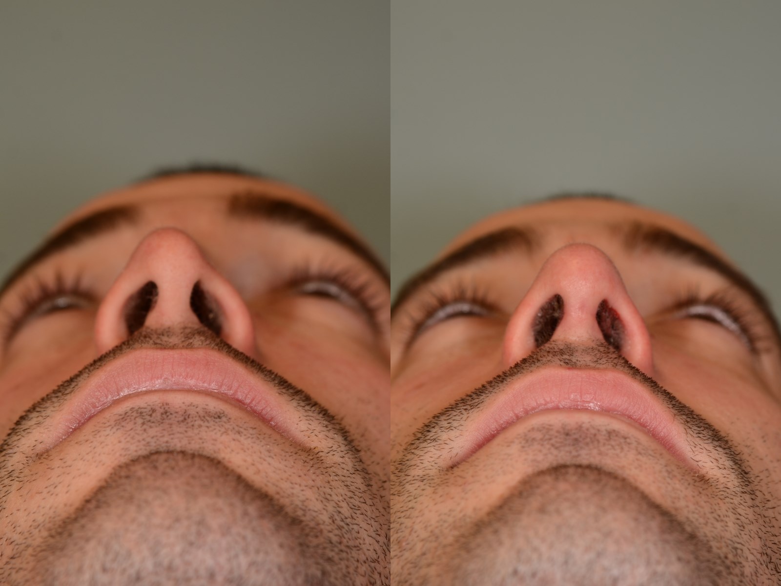 Repair of Nasal Valve Collapse Before and After