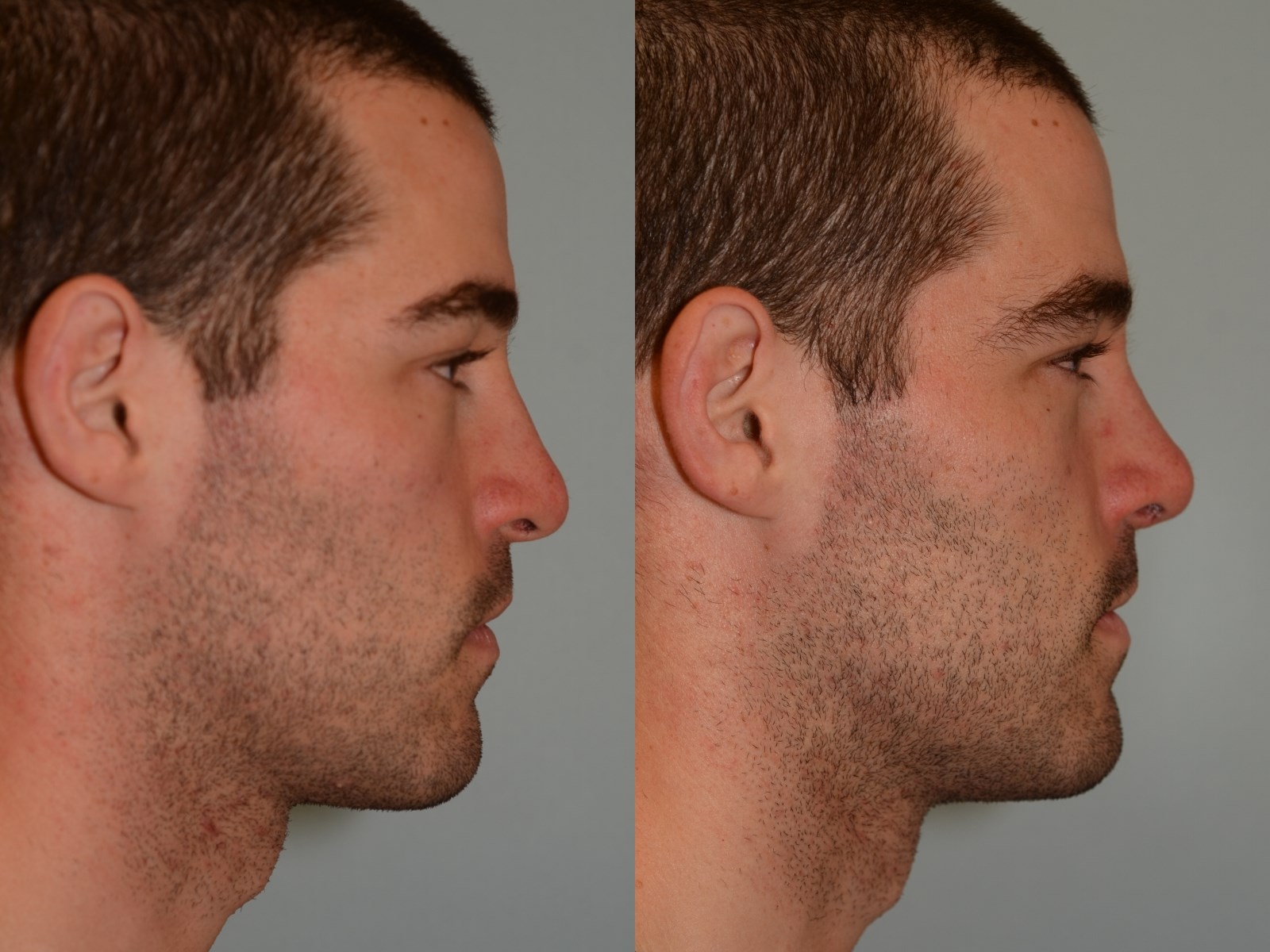 Breathing Restored! Before and After