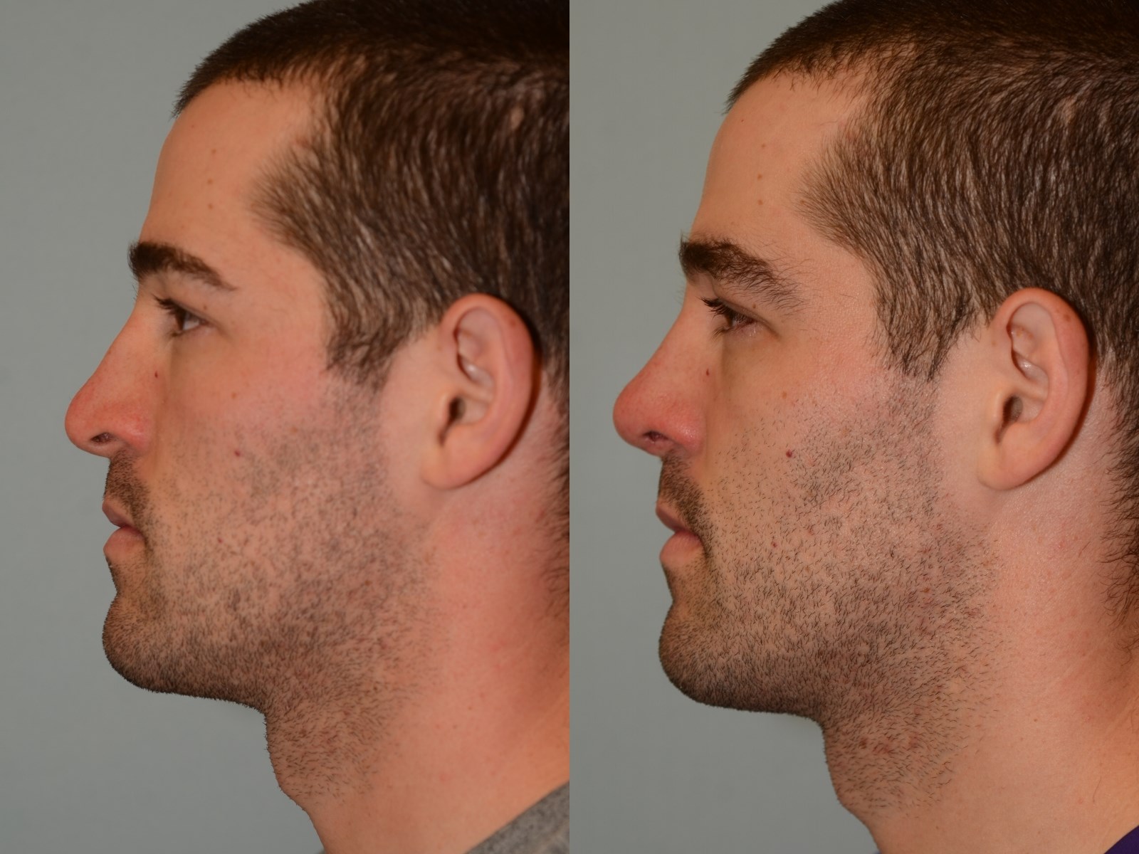 Breathing Restored! Before and After