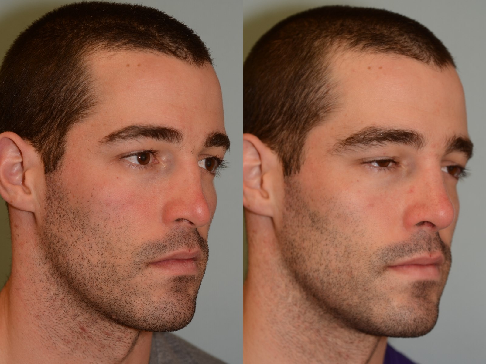 Notice the improved slope Before and After