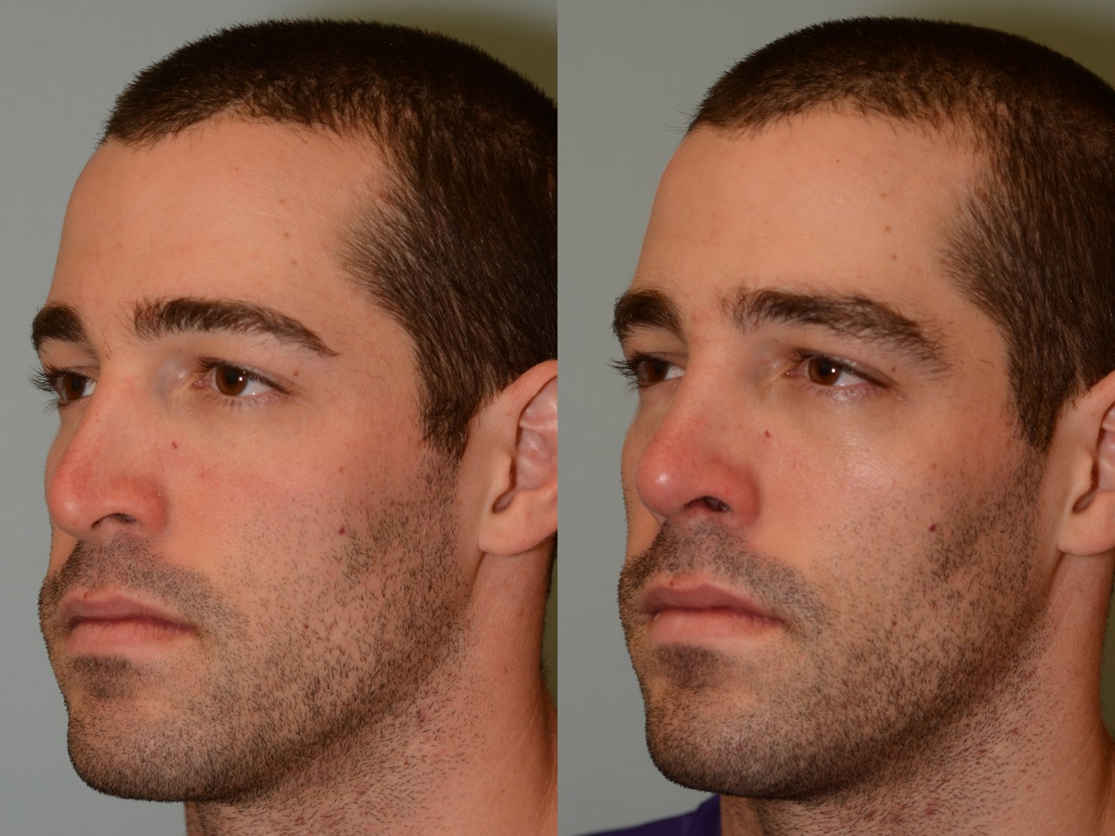 Notice the improved slope Before and After