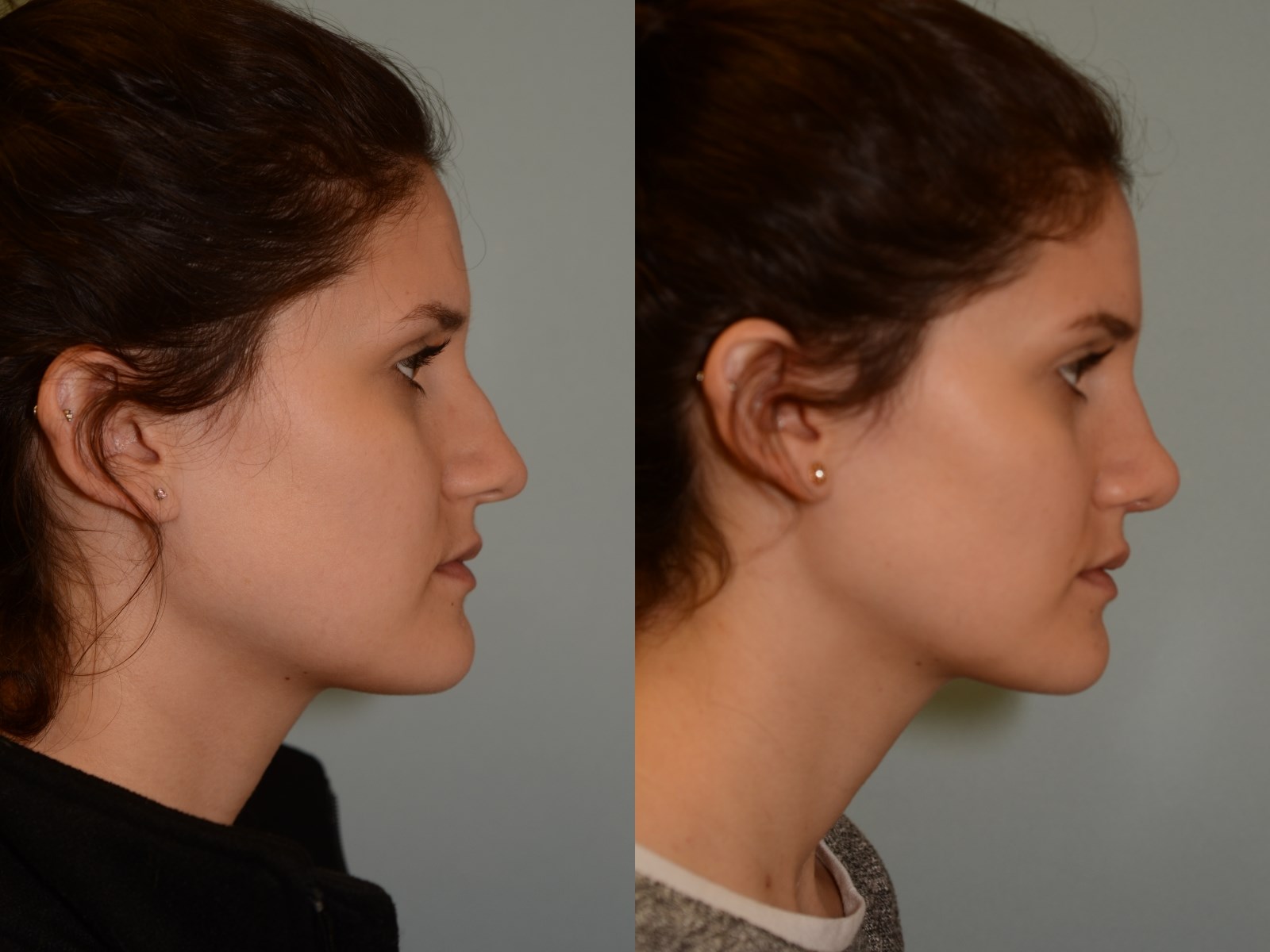 Notice no more dorsal hump Before and After