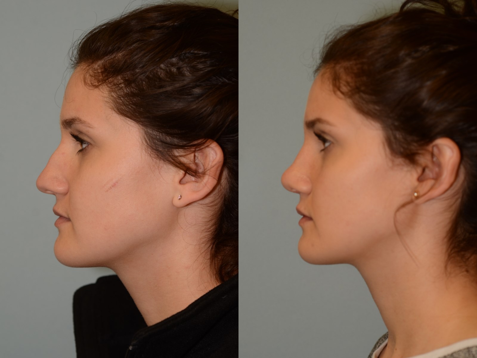 Notice no more dorsal hump Before and After