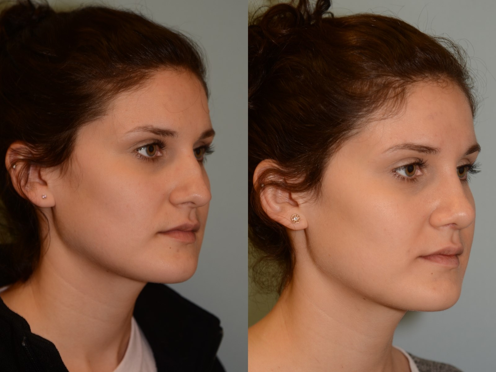 A soft feminine nasal slope Before and After