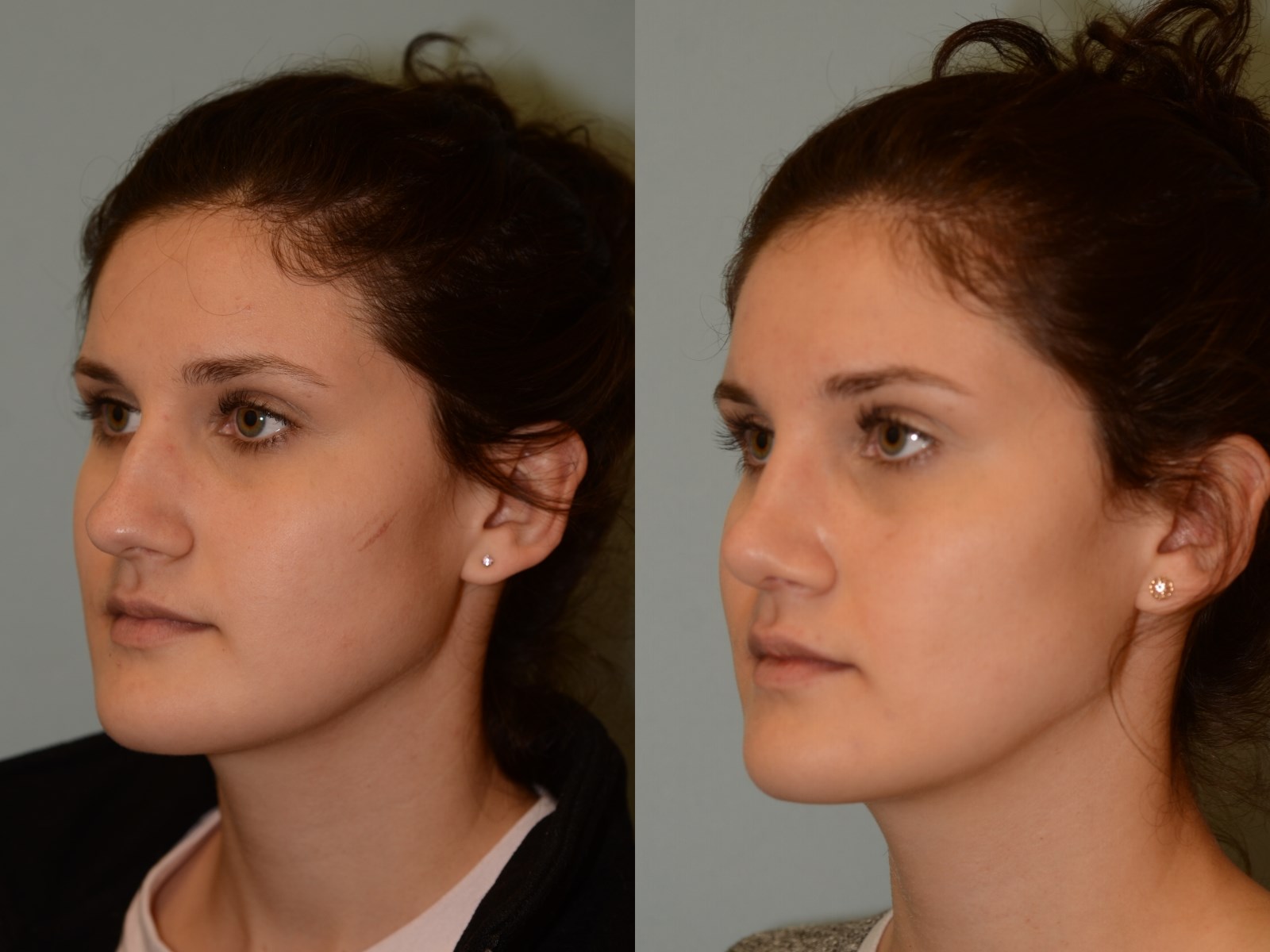 A soft feminine nasal slope Before and After